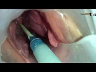 sperm injection into uterus