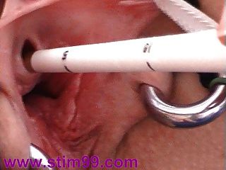 urethra ibrator